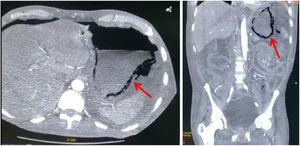 Tomografía computarizada de abdomen con hallazgo de neumatosis de la pared gástrica (flecha roja); corte axial (lado izquierdo) y coronal (lado derecho).