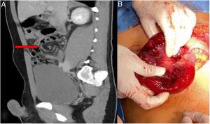 A) Vista sagital de la TC de abdomen; la flecha roja indica el signo de remolino en el mesenterio del íleon terminal. B) Imagen intraoperatoria que muestra la isquemia intestinal.