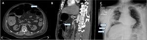 A) TC que muestra neumoperitoneo (flecha). B) TC que muestra trombosis de arteria mesentérica superior (flecha). C) Radiografía torácica que muestra aire subdiafragmático (flechas).