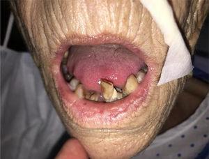 Gingivitis crónica con edentulismo.