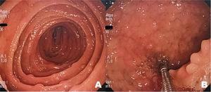 Endoscopía alta. A) La mucosa yeyunal se encuentra con lesiones nodulares dispersas. B) Bulbo duodenal con múltiples lesiones nodulares, algunos segmentos se visualizan con patrón en empedrado.