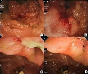 A) Íleon terminal con mucosa friable con presencia de lesiones nodulares y pseudopolipoideas. B) Úlcera transversal superficial en íleon terminal. C y D) Válvula ileocecal ulcerada y edematosa.