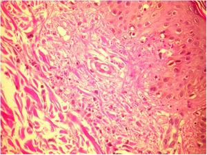 Biopsia de lesiones cutáneas presentando vasculitis leucocitoclástica (tinción hematoxilina-eosina [H&E], ×40).