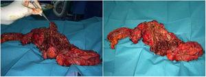 Pieza quirúrgica tras sigmoidectomía e intervención de Hartmann con presencia de múltiples pólipos worm-like.