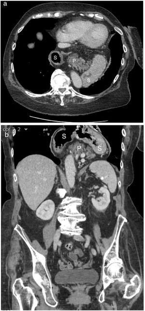 Imágenes de TC del páncreas intratorácico. Imagen de TC axial (a) y coronal (b) donde se muestra la hernia total de estómago (S), asociada con un páncreas casi completamente herniado (P).