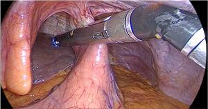 Disparo de sutura mecánica en trayecto de fístula gastrocutánea.