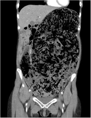 Tomografía computarizada con medio de contraste, donde se observa dilatación gástrica y gas en la vena porta, sin aparente isquemia gastrointestinal.