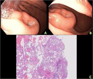 A y B. Imagen de endoscopia digestiva alta en la que se visualiza una lesión mamelonada con depresión central y ulcerada, localizada en la unión de las curvaturas mayor y menor gástricas. C. Corte histológico de la lesión, tinción HE, aumento ×40. Se observa una lesión nodular submucosa, ulcerada, con tejido de granulación. Subyacente a la úlcera hay adipocitos maduros, sin atipias nucleares, lipoblastos ni células pleomórficas, entremezcladas con fibroblastos.