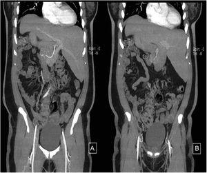 Colangioresonancia magnética a distintos planos. A y B) Se evidencia colelitiasis, catéter en vesícula biliar y situs inversus abdominal total.
