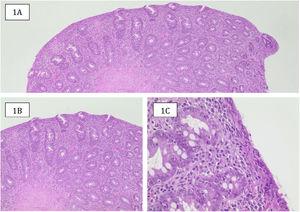 Muestra histológica de una paciente de la serie catalogada como Marsh3b. A)Hematoxilina/eosina (HE) 4×. Se ve mucosa duodenal de superficie plana (sin vellosidades), con hiperplasia de criptas. B)HE 10×. Hiperplasia de criptas, infiltrado inflamatorio aumentado de lámina propia. C)HE 40×. Infiltrado inflamatorio rico en células plasmáticas de lámina propia, epitelio de superficie disminuido de altura, de contenido mucinoso y con numerosos linfocitos en su interior. Fuente: Gentileza de la Dra. Laura Carreño T.