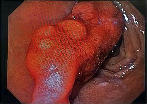 Esofagogastroduodenoscopia; se observa pólipo pediculado en bulbo duodenal, aproximadamente de 4cm de diámetro en la primer porción del duodeno con datos de sangrado activo.