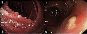 a) Duodeno con mucosa nodular blancuzca; b) Úlcera en el íleon distal.