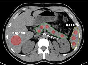 Cálculo medición densidad de parénquima hepático en un ROI (region of interest) extenso a nivel de segmentos VI y VII en TAC.