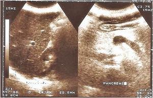 Varón de 21años. Imagen ecográfica de páncreas con aumento de ecogenicidad consistente con infiltración grasa.