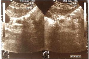 Mujer de 31 años. Imagen ecográfica donde se visualizan quistes de pequeño tamaño distribuidos por todo el páncreas.
