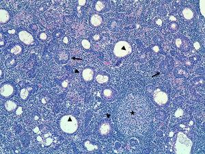 Hematoxilina-eosina 10×: se observa una proliferación de nidos epiteliales sólidos (flecha) y quísticos (punta de flecha) bien delimitados, rodeados por un estroma linfoide denso, maduro, sin atipia, con presencia de centros germinales (estrella).