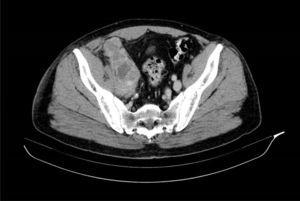 Imagen del TAC abdominal donde se objetiva el tamaño del tumor retroperitoneal que engloba vasos iliacos derechos con áreas de necrosis y distinta heterogeneidad.