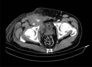 Imagen del TAC abdominal urgente con gran hematoma en retroperitoneo y extravasación de contraste por la arteria iliaca externa derecha.