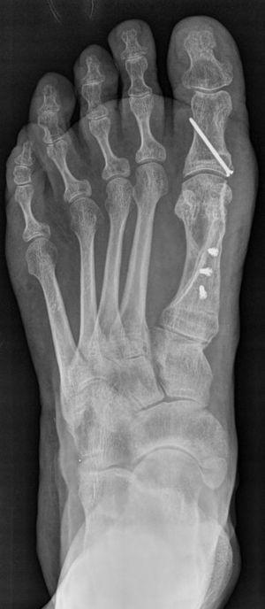 Radiografía AP de pie, luego de una osteotomía tipo Scarf. Se muestra con 3 tornillos de fijación al primer metatarsiano.