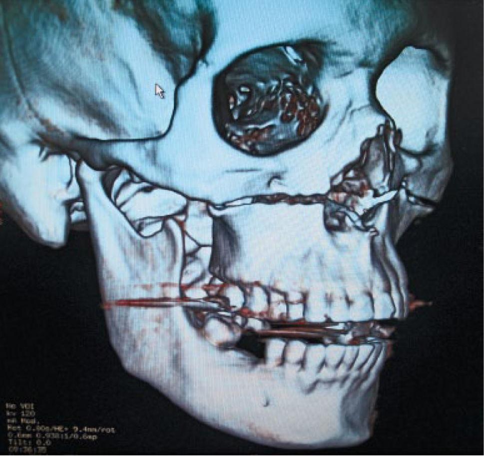 OSTEOLOGÍA DEL MAXILAR Y LA MANDÍBULA: Cuando canto, mi cara