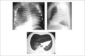 ENFISEMA LOBAR CONGÉNITO EN RNT GEG Evoluciona con dificultad respiratoria desde el nacimiento. Rx Tx plantea sospecha del diagnóstico, el que se confirma con TAC pulmonar.
