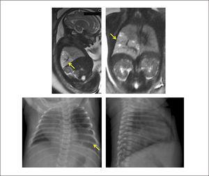SECUESTRO PULMONAR INTRALOBAR Imagen de resonancia magnética fetal y Rx Tx posnatal que muestra consolidación en base izquierda.