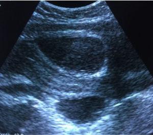 Ecografía post-himenotomía: útero de 12×5×4cm con línea endometrial de 4mm y múltiples colecciones en cavidad abdominal, la mayor de 8cm×11cm.