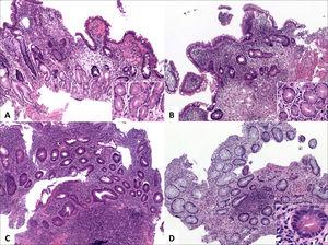 Alteraciones distintivas de colitis crónica.