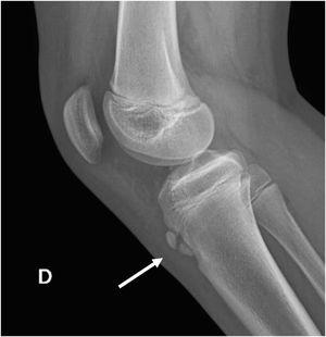 Enfermedad de Osgood Schlatter. Radiografía lateral de rodilla con fragmentación de apófisis de la tuberosidad anterior de la tibia (flecha) en paciente de sexo masculino de 14 años portador de enfermedad de Osgood Schlatter.
