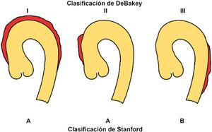Representación esquemática de las clasificaciones de DeBakey de Stanford para los síndromes aórticos agudos.