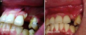 a) Paciente de 19 años, enero 2008 secuela trauma maxilo facial. b) Mayo 2009 estabilidad tisular poscirugía reconstructiva.