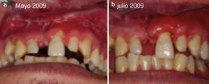 a) Paciente de 27 años. Mayo 2009 secuela trauma maxilofacial. b) Julio 2009 poscirugía reconstructiva tejidos blandos.