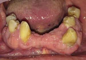 Agrandamiento gingival mandibular en paciente adulto bajo tratamiento con ciclosporina.