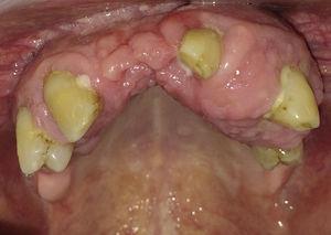 Agrandamiento gingival maxilar en paciente adulto bajo tratamiento con ciclosporina.
