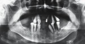 Ortopantomografía: compromiso periodontal severo. Reabsorción ósea marginal profunda, casi completa en grupos III y VI.