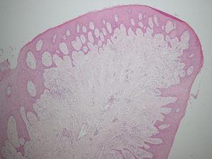 Corte histológico (×4). Hiperplasia seudopapilomatosa del epitelio escamoso.