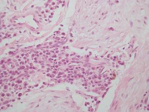 Corte histológico (×40). Se observa infiltrado inflamatorio, plasmocitos y linfocitos.