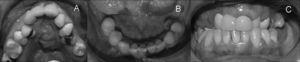 Fotografías iniciales de la paciente. A. Oclusal superior (arcada con forma triangular). B. Oclusal inferior. C. Arcadas en oclusión (mordida cruzada bilateral severa).
