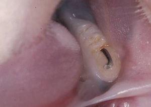 View of orthodontic wire adhered to the surface of the mandibular first molar.