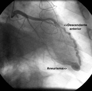 Imagem de pequena fístula da artéria descendente anterior distal para o ventrículo direito com aneurisma associado na coronariografia após dois anos de transplante cardíaco.