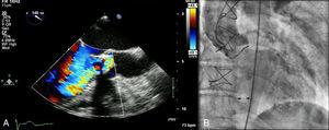 Insuficiência aórtica demonstrada por ecocardiograma transesofágico (A) e aortografia (B).