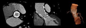 Imagens de tomografia computorizada multidetetores evidenciando o correto posicionamento e expansão da CoreValve, 6 meses após a implantação.