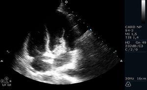 Ecocardiograma transtorácico: massa aderente ao folheto anterior da válvula mitral que durante a diástole faz protusão para o interior do ventrículo esquerdo.