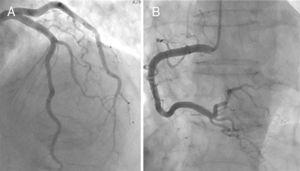 Cateterismo cardíaco numa doente com MT que revelou coronárias normais. A) Coronária esquerda. B) Coronária direita.