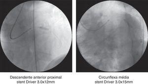 Intervenção coronária percutânea sobre as lesões observadas no angiograma diagnóstico. Técnica utilizada – stent direto.