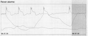 Elevação transitória do segmento ST na monitorização eletrocardiográfica contínua.