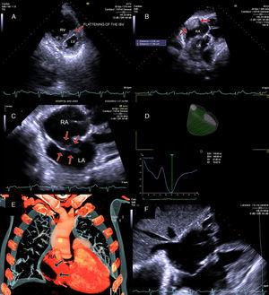 (A) Transthoracic echocardiography (TTE) image showing marked dilatation of the right chambers with systolic-diastolic flattening of the interventricular septum (IVS); (B) 3D TTE estimation of right ventricularejection fraction; (C) 2D TTE showing a large thrombus onthe right atrium (RA) lateral wall; (D) 2D TTE showing a thrombus through the patentforamen ovale(PFO); (E) Thoracic computed tomography angiographyshowing alarge thrombus onthe RA lateral wall; (F) 2D TTE showing the disappearance of the thrombus through the PFO, after one week of anticoagulation.