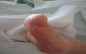 Skin lesion affecting right hallux.