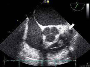Transesophageal 61° view of aortic valve. Pulmonary valve vegetation is indicated by the white arrow.