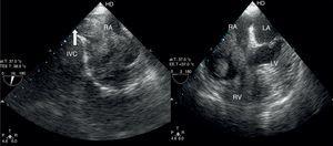 Transesophageal echocardiography. Bicaval (left) and 4-chamber view (right) showing an elongated mass extending from the inferior vena cava through the right atrium and crossing the tricuspid valve into the right ventricle. IVC: inferior vena cava; LA: left atrium; LV: left ventricle; RA: right atrium; RV: right ventricle.